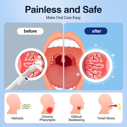 Visible Electric Tonsil Stone Removal Kit with HD Camera & LED Light